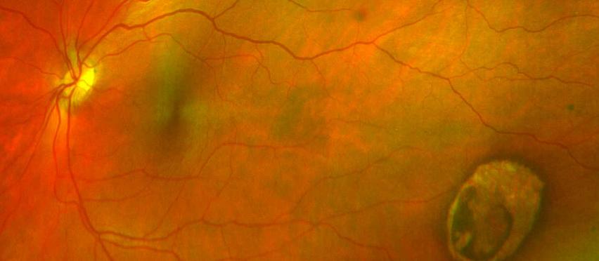 The Treatment and Management of Eye Disease